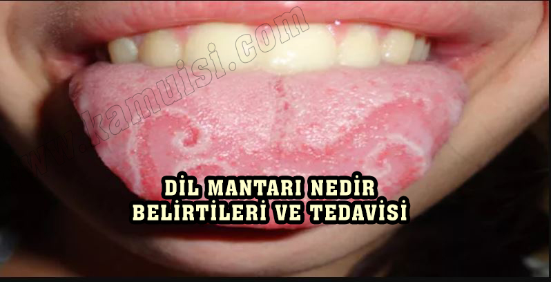 DİL MANTARI NEDİR